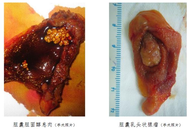 胆囊结石论文借鉴资源，胆囊结石毕业论文-第5张图片-优浩百科